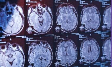 Scan Of A Person With Dementia
